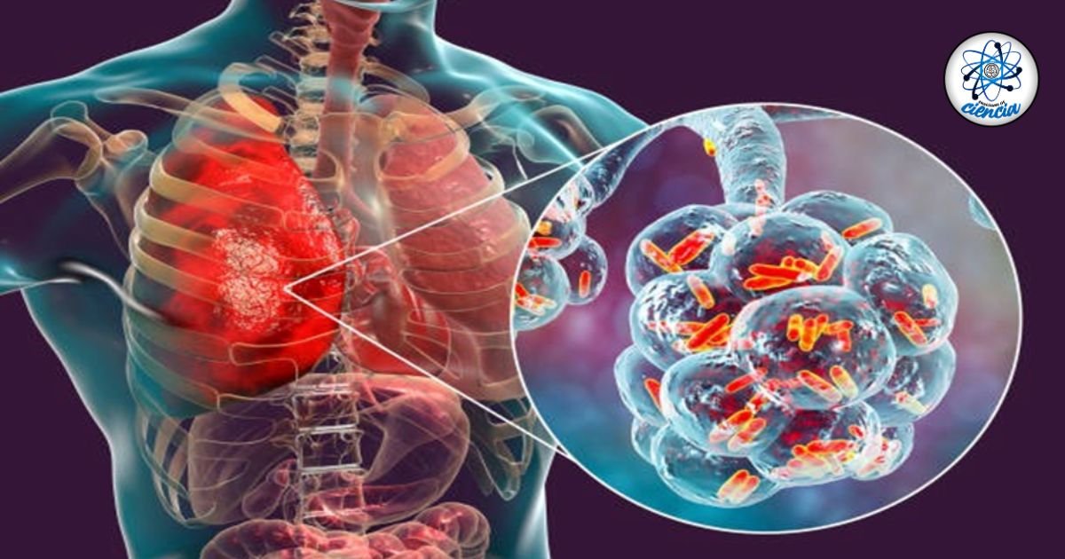 Tuberculosis: Primera causa de muerte por enfermedad infecciosa, según la OMS